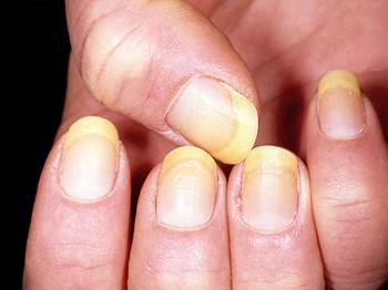 Nails say about your health?